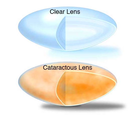 Cataract Lens