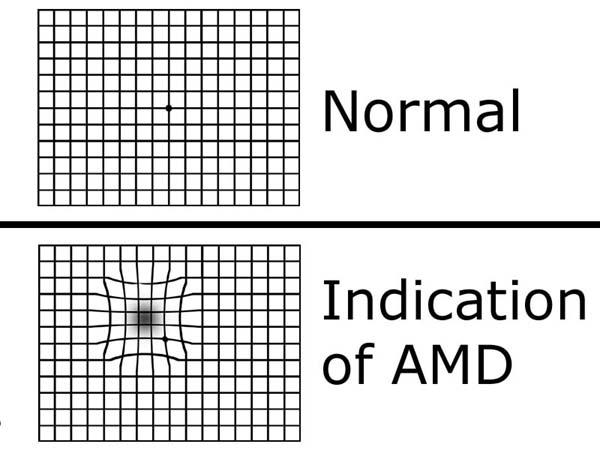 Macular Degeneration