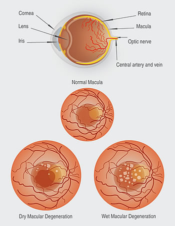 Macular Degeneration