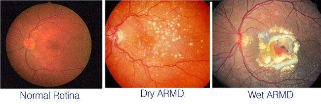 Macular Degeneration FUNDUS