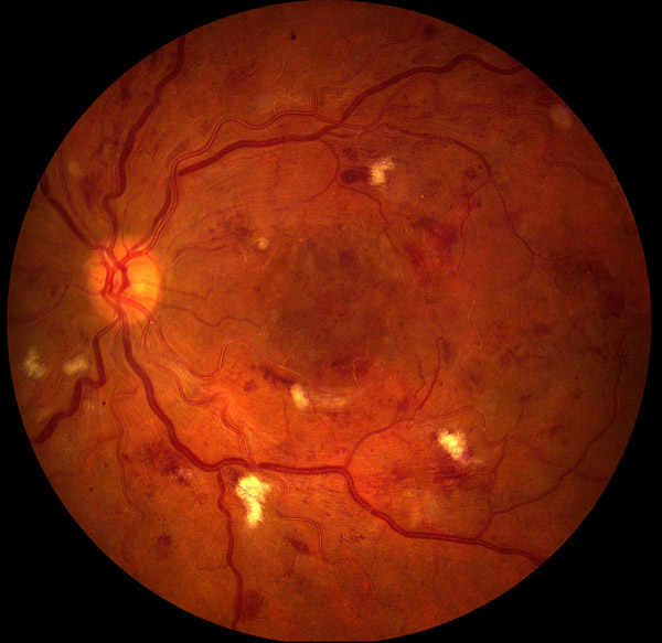 Diabetic FUNDUS