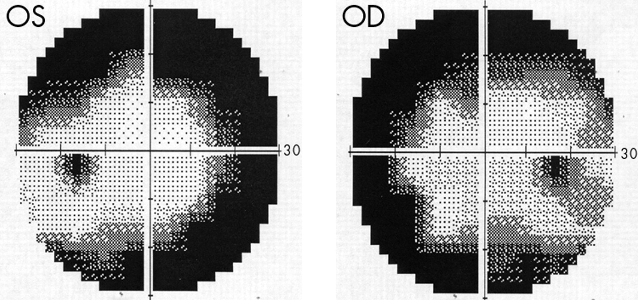 Glaucoma Visual Field