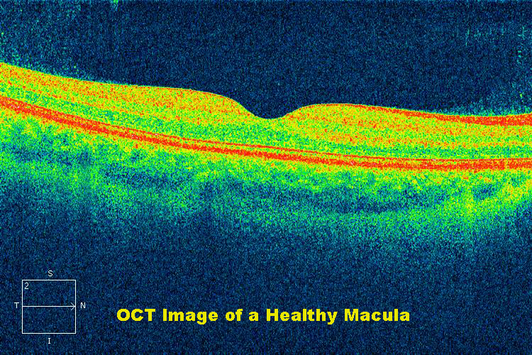 Macular OCT