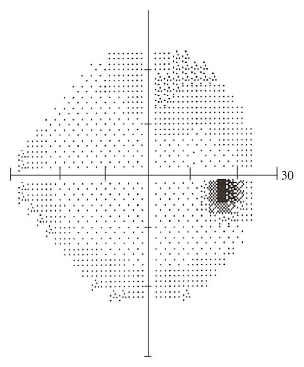 Normal Visual Field